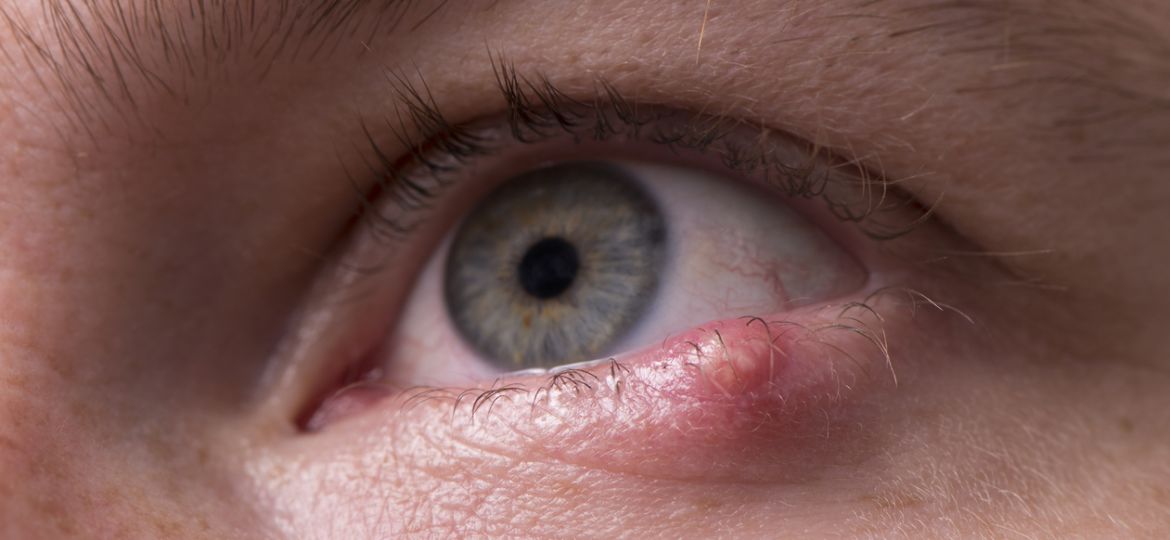 Close up on infected eye with painful lump on the lower eyelid.