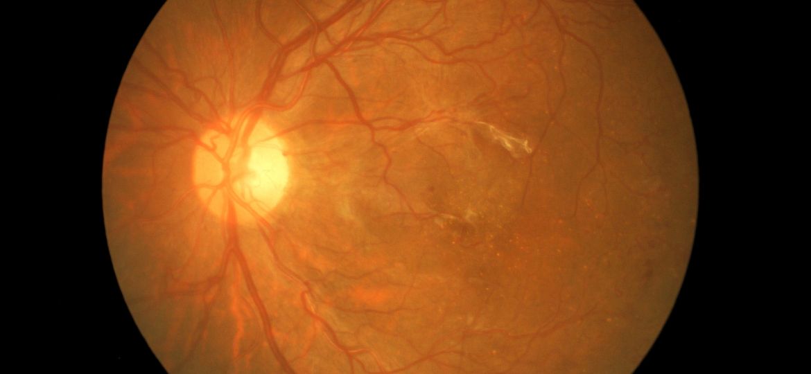 medical photo diabetic retinopathy neovascularization